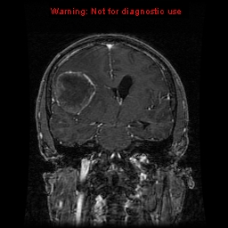 File:Bronchogenic carcinoma brain metastasis (Radiopaedia 9286-9969 Coronal T1 16).jpg