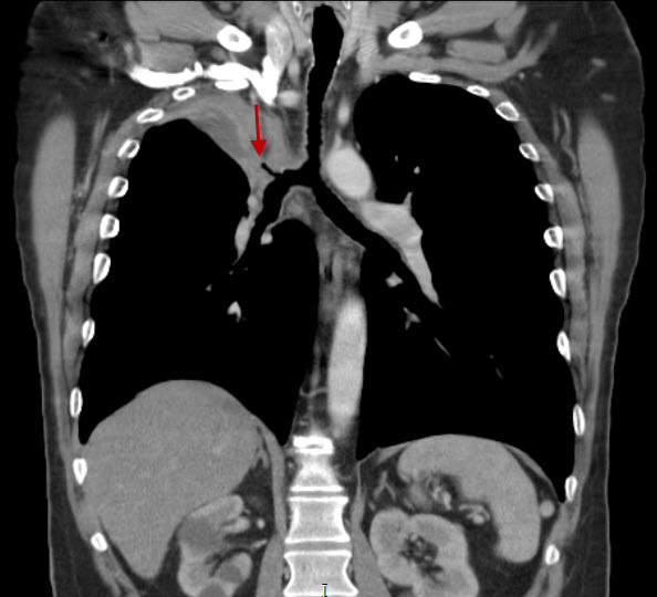 File:Bronchogenic carcinoma with upper lobe collapse (Radiopaedia 29297-29727 A 1).jpg
