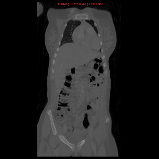File:Brown tumor (Radiopaedia 12318-12596 D 23).jpg