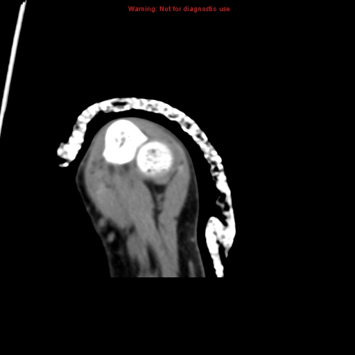 File:Brown tumor (Radiopaedia 12460-12694 Axial non-contrast 128).jpg