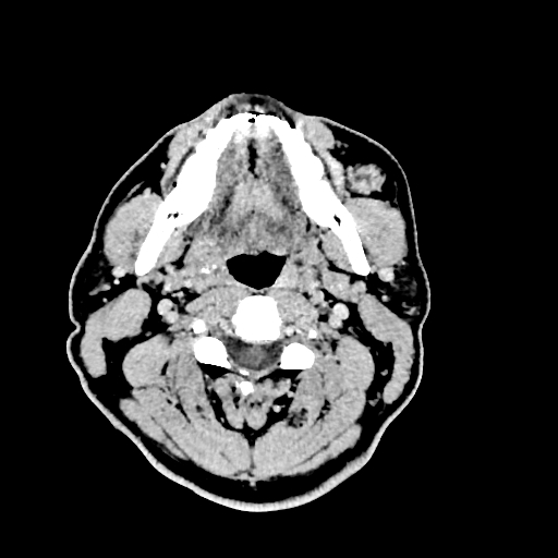 Buccal fat pad arteriovenous malformation (Radiopaedia 70936-81142 Axial non-contrast 14).jpg