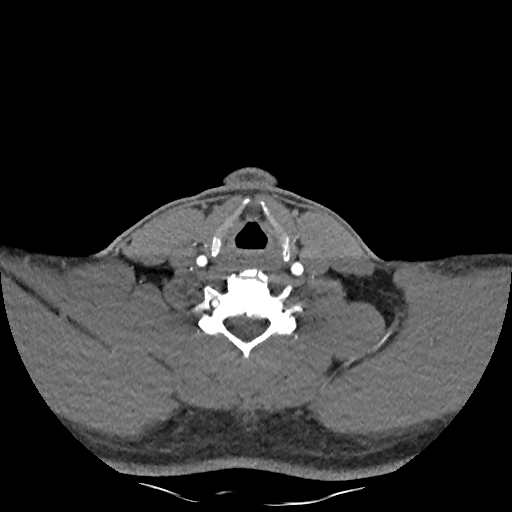 Buccal fat pad arteriovenous malformation (Radiopaedia 70936-81144 D 100).jpg