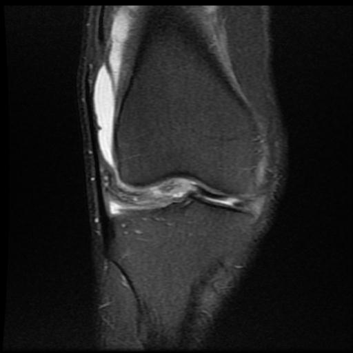 File:Bucket handle tear - medial meniscus (Radiopaedia 69245-79026 Coronal PD fat sat 7).jpg
