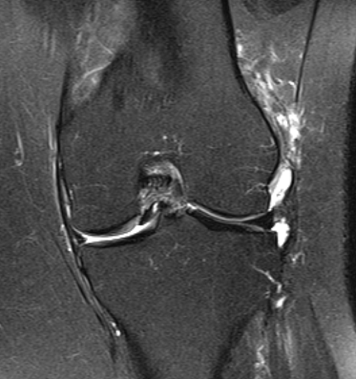 File:Bucket handle tear - medial meniscus (Radiopaedia 79028-91942 Coronal PD fat sat 8).jpg