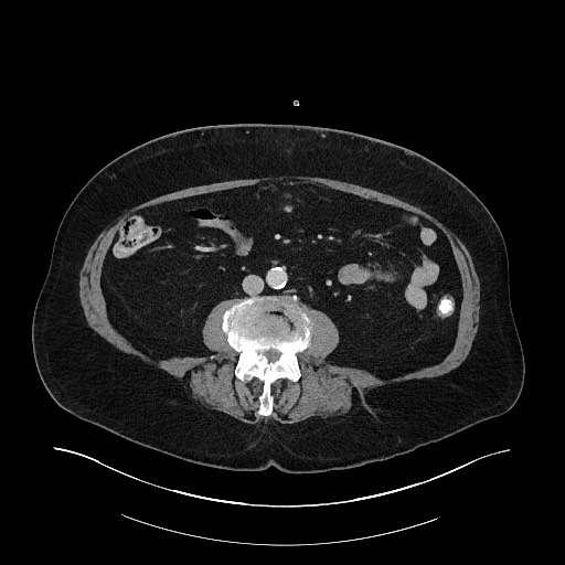 File:Buried bumper syndrome - gastrostomy tube (Radiopaedia 63843-72575 A 51).jpg