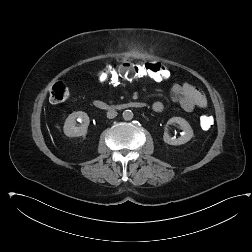 File:Buried bumper syndrome - gastrostomy tube (Radiopaedia 63843-72577 Axial Inject 50).jpg