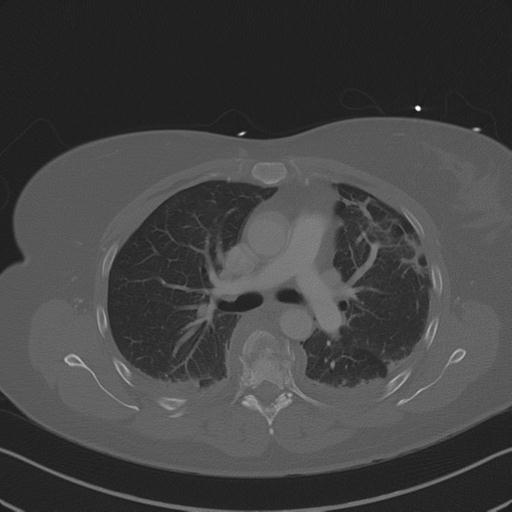 Burst fracture - thoracic spine (Radiopaedia 30238-30865 Axial bone window 42).jpg