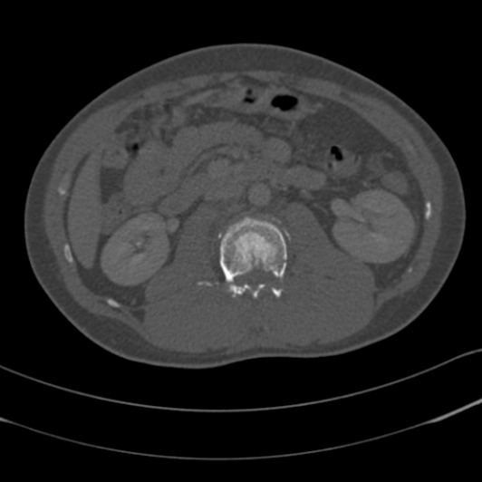 Burst fracture with cauda equina syndrome (Radiopaedia 25701-25867 Axial bone window 47).jpg
