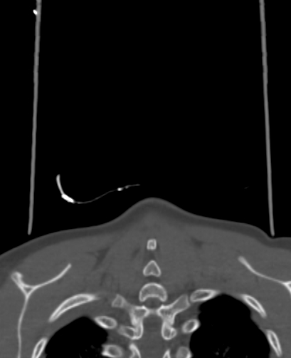 Butterfly vertebra (Radiopaedia 77903-90209 Coronal bone window 110).jpg