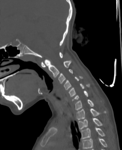 File:Butterfly vertebra (Radiopaedia 77903-90209 Sagittal bone window 38).jpg