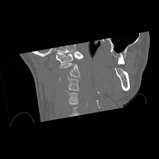 C1-C2 "subluxation" - normal cervical anatomy at maximum head rotation (Radiopaedia 42483-45607 Coronal non-contrast 13).jpg