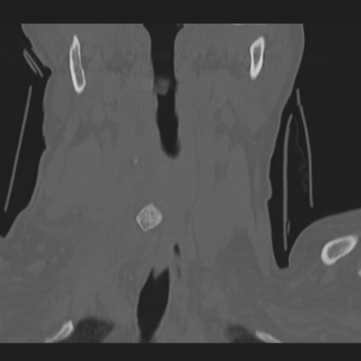 File:C2 fracture (Radiopaedia 34091-35341 Coronal bone window 9).png