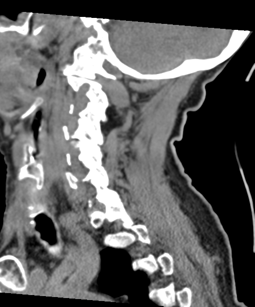 C2 fracture with vertebral artery dissection (Radiopaedia 37378-39199 D 27).png