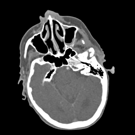 C2 fracture with vertebral artery dissection (Radiopaedia 37378-39200 A 217).png