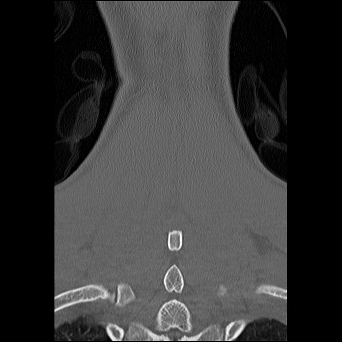 C5 facet fracture (Radiopaedia 58374-65499 Coronal bone window 54).jpg