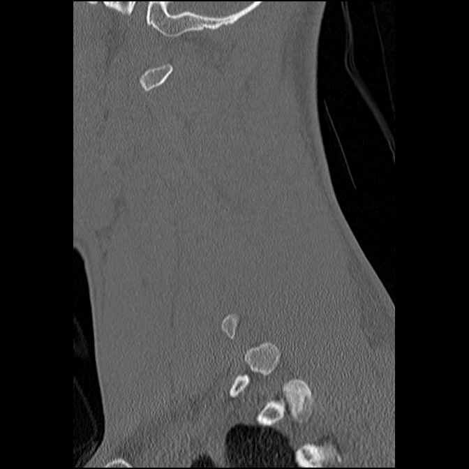 C5 facet fracture (Radiopaedia 58374-65499 Sagittal bone window 21).jpg