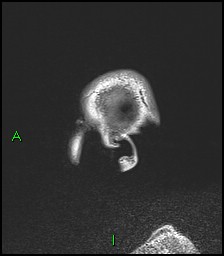 CNS manifestations of NF1 - optic pathway glioma, neurofibroma, dural ectasia (Radiopaedia 37874-39805 Sagittal FLAIR 141).jpg
