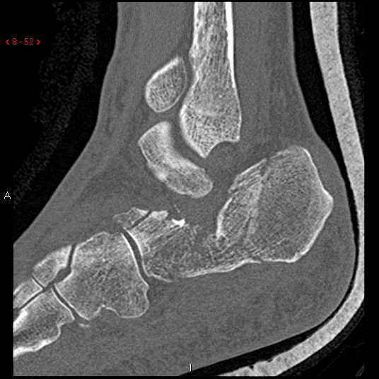 File:Calcaneal fracture and associated spinal injury (Radiopaedia 17896-17656 Sagittal bone window 6).jpg