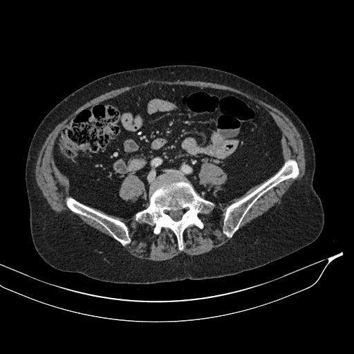Calcified adrenal glands and Spigelian hernia (Radiopaedia 49741-54988 A 147).jpg