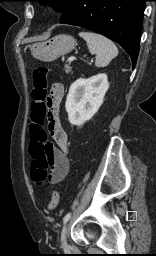 Calcified adrenal glands and Spigelian hernia (Radiopaedia 49741-54988 C 41).jpg