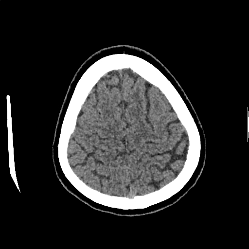 Calcified cerebral hydatid cyst (Radiopaedia 65603-74717 Axial non-contrast 67).jpg