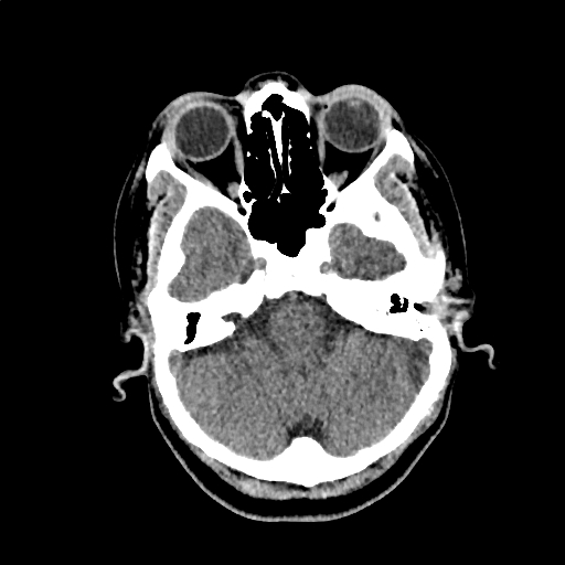 Calcified cerebral hydatid cyst (Radiopaedia 65603-74717 Axial non-contrast 9).jpg