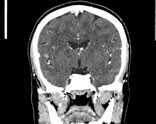 Calcified cerebral hydatid cyst (Radiopaedia 65603-74717 C 32).jpg