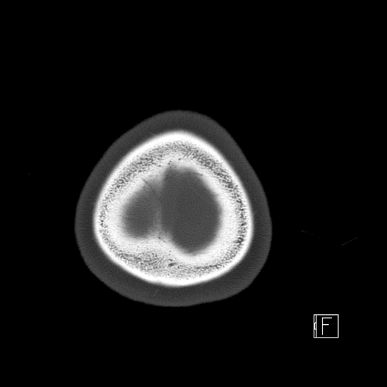 Calcified chronic subdural hematoma (Radiopaedia 77374-89492 Axial bone window 133).jpg