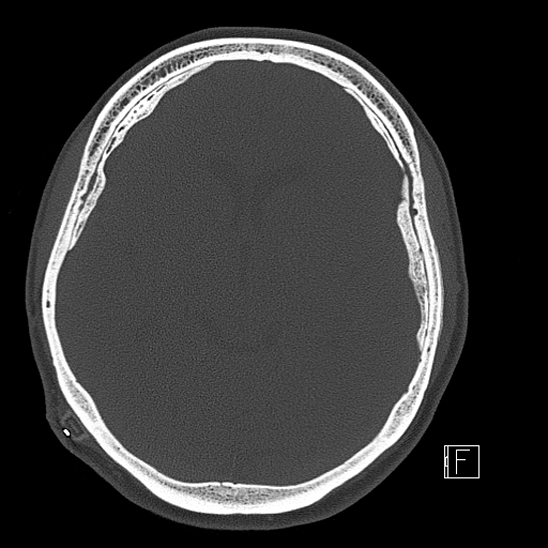 Calcified chronic subdural hematoma (Radiopaedia 77374-89492 Axial bone window 61).jpg