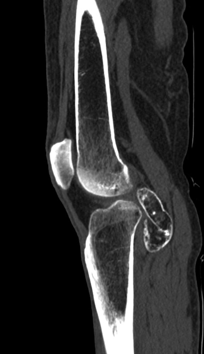 Calcified hematoma - popliteal fossa (Radiopaedia 63938-72763 Sagittal bone window 67).jpg