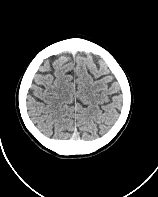 Calcified meningioma (Radiopaedia 74361-85243 Axial non-contrast 12).jpg