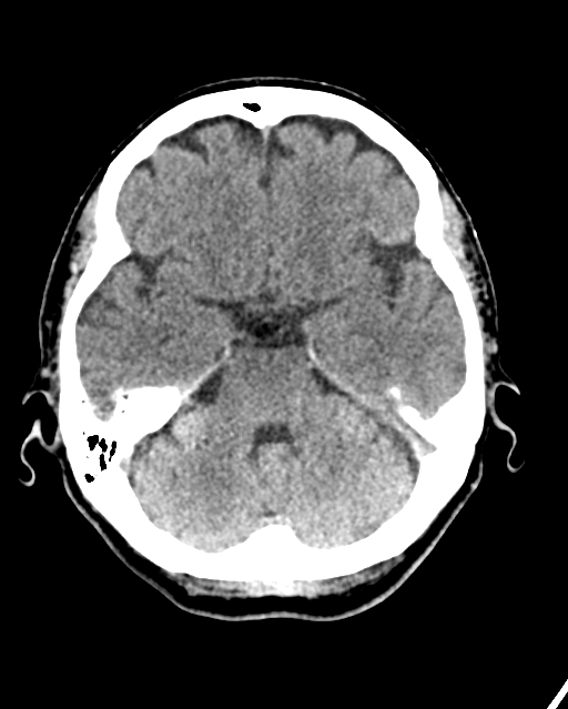 Calcified meningioma (Radiopaedia 74361-85243 Axial non-contrast 35).jpg