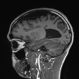 File:Callosal dysgenesis with interhemispheric cyst (Radiopaedia 53355-59335 Sagittal T1 58).jpg