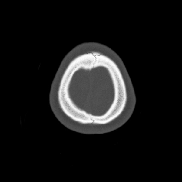Calvarial osteoma (Radiopaedia 36520-38079 Axial bone window 102).jpg