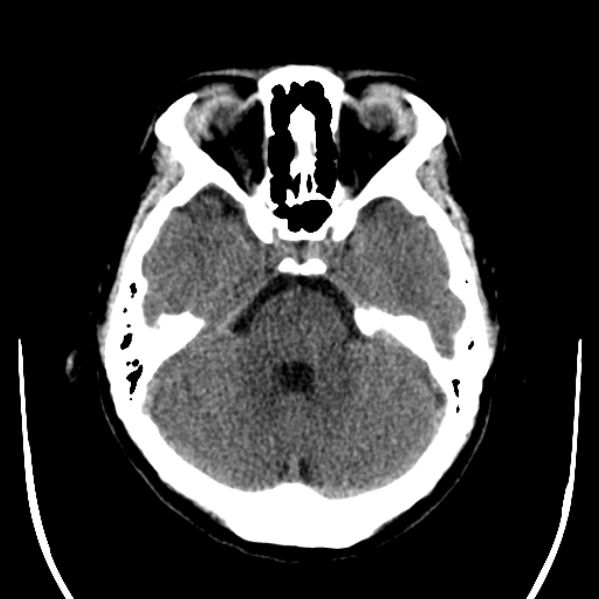 Calvarial osteoma (Radiopaedia 36520-38079 Axial non-contrast 17).jpg