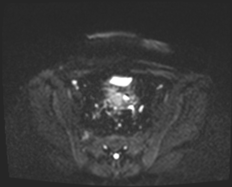Cancer cervix - stage IIb (Radiopaedia 75411-86615 Axial DWI 22).jpg