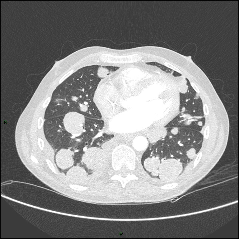 Cannonball metastases (Radiopaedia 82110-96150 Axial lung window 127).jpg