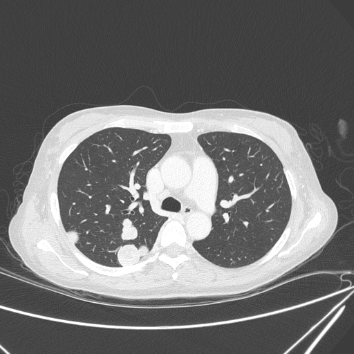 Canonball lung metastasis (Radiopaedia 77634-89837 Axial lung window 66).jpg