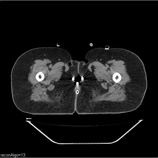 Carcinoma cervix- brachytherapy applicator (Radiopaedia 33135-34173 Axial non-contrast 62).jpg
