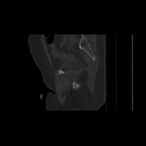 Carcinoma cervix- brachytherapy applicator (Radiopaedia 33135-34173 Sagittal bone window 134).jpg