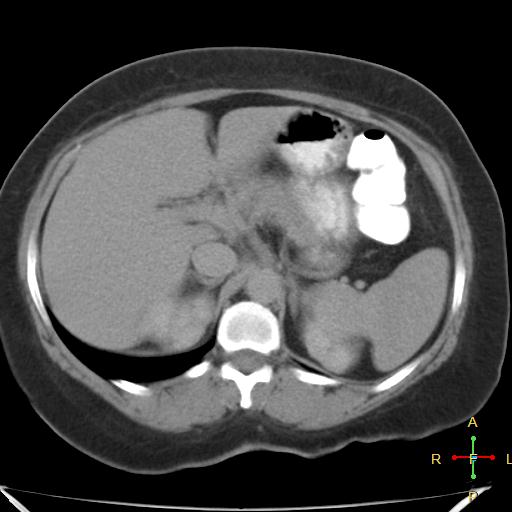 File:Carcinoma of sigmoid colon (Radiopaedia 23071-23100 C+ delayed 5).jpg