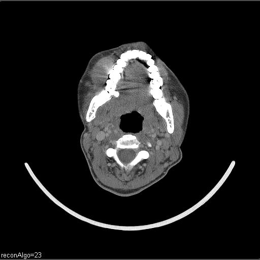 Carcinoma of the maxillary antrum (Radiopaedia 53805-59888 Axial C+ delayed 37).jpg