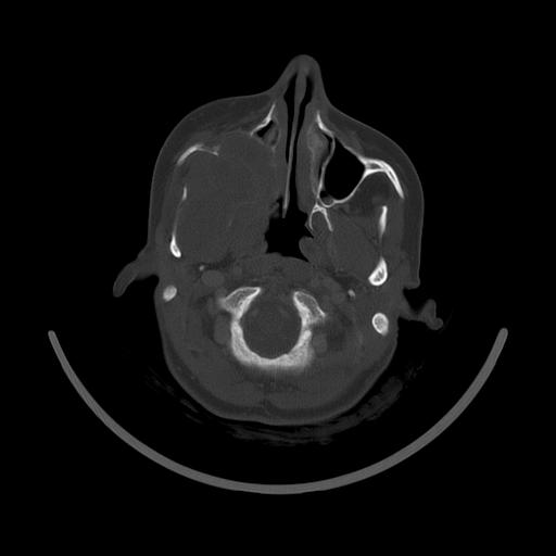 Carcinoma of the maxillary antrum (Radiopaedia 53805-59888 Axial bone window 54).jpg