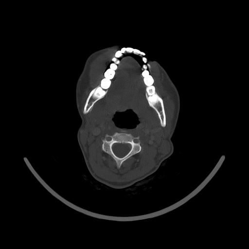 Carcinoma of the maxillary antrum (Radiopaedia 53805-59888 Axial bone window 95).jpg