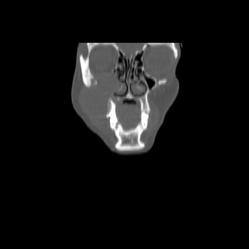 Carcinoma of the maxillary antrum (Radiopaedia 53805-59888 Coronal bone window 28).jpg