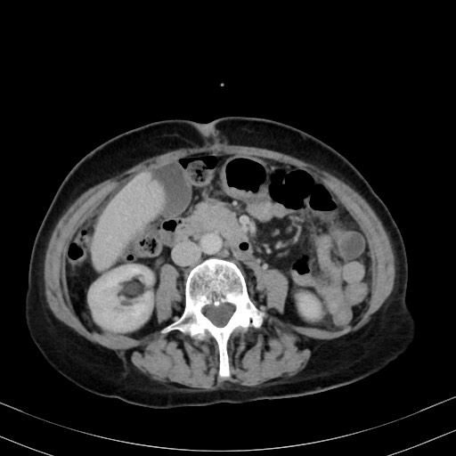 Carcinosarcoma (Radiopaedia 70401-80503 A 32).jpg