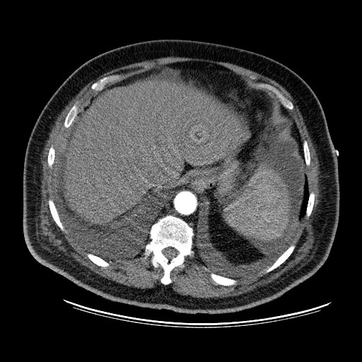 File:Cardiac lymphoma (Radiopaedia 38690-40836 Axial C+ CTPA 20).jpg