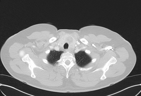 File:Cardiac sarcoidosis (Radiopaedia 74548-85534 Axial lung window 7).jpg