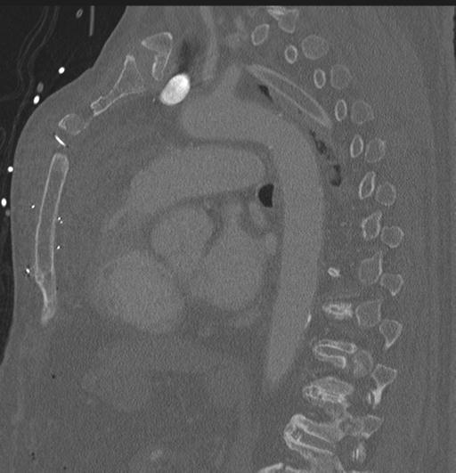 Cardiac trauma (Radiopaedia 32874-33858 Sagittal bone window 24).jpg