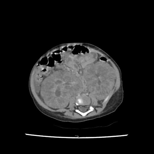 Caroli disease with autosomal recessive polycystic kidney disease (ARPKD) (Radiopaedia 89651-106703 B 147).jpg
